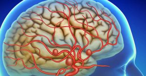 Aneurisma cerebral sinais de alerta e quando procurar um especialista
